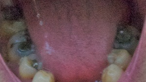 Heavily filled teeth