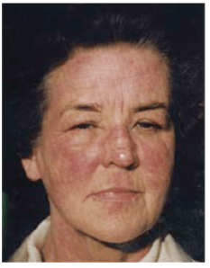 Jennifer Worth at the worst of her eczema